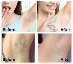 Best Hair Removal for Private Parts of Female